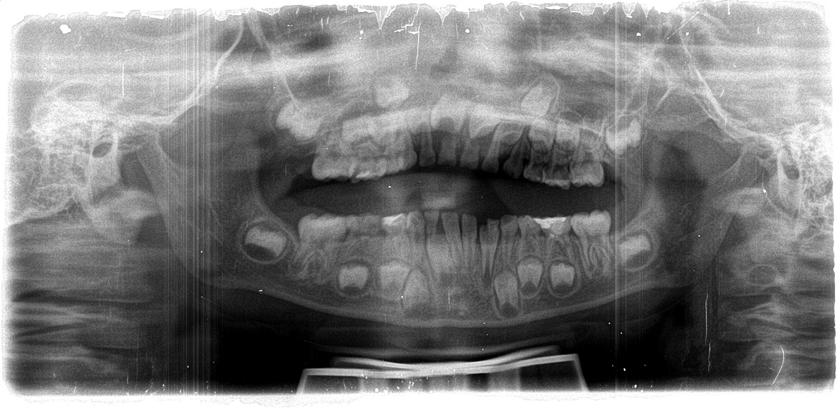 乳歯 レントゲン