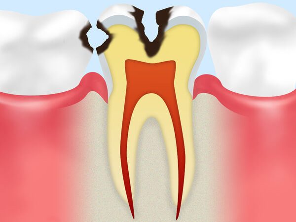 C2（象牙質のむし歯）
