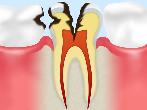 C3（神経にまでおよんだむし歯）