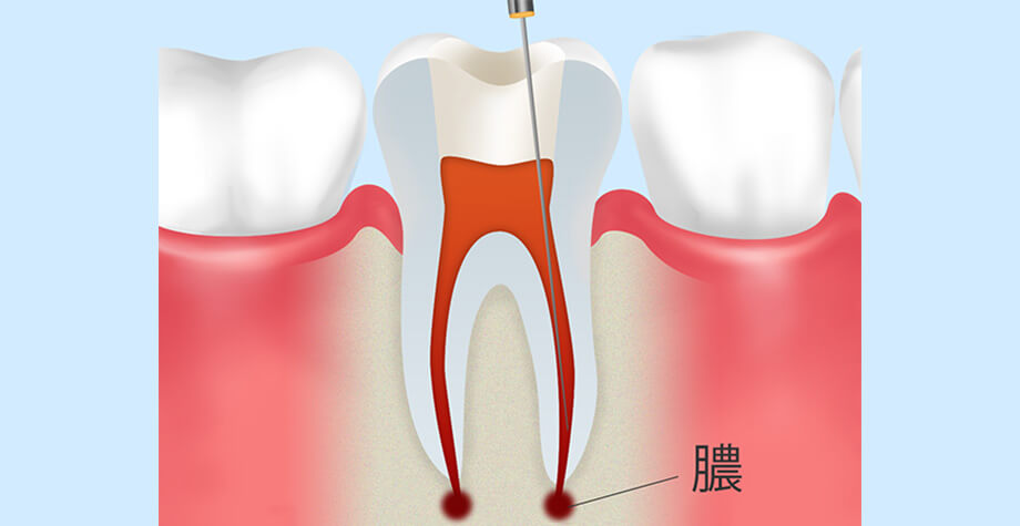 神経までおよんだむし歯治療について