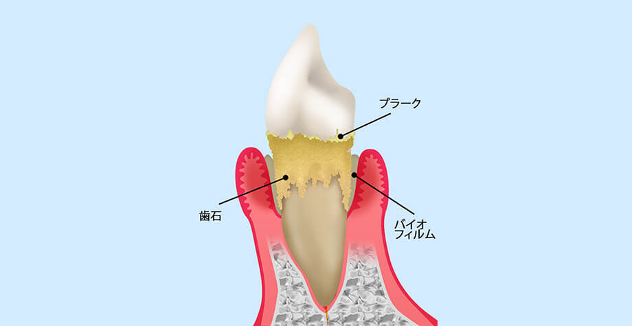 歯周病とは