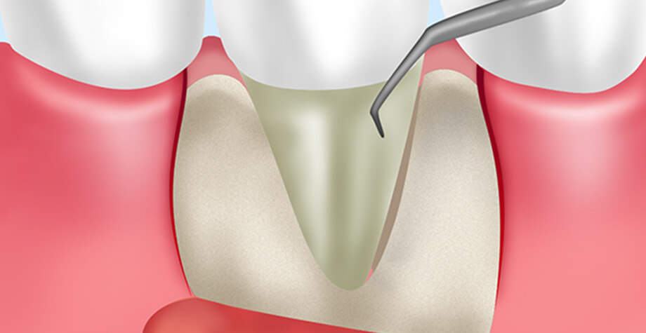 歯周病の外科的治療