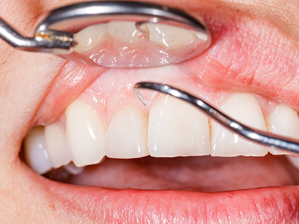 ⑤ 歯周病の検査