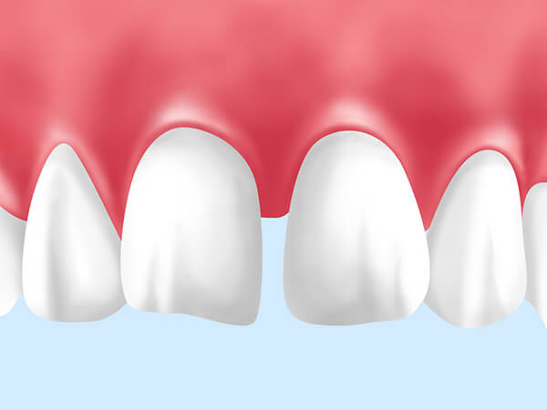 空隙歯列（くうげきしれつ）・正中離開（せいちゅうりかい）