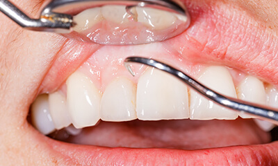 歯周病は早めの治療がカギ！